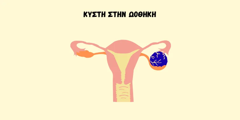 ΑΠΕΙΚΟΝΙΣΗ ΜΗΤΡΑΣ ΜΕ ΚΥΣΤΗ ΣΤΗΝ ΩΟΘΗΚΗ