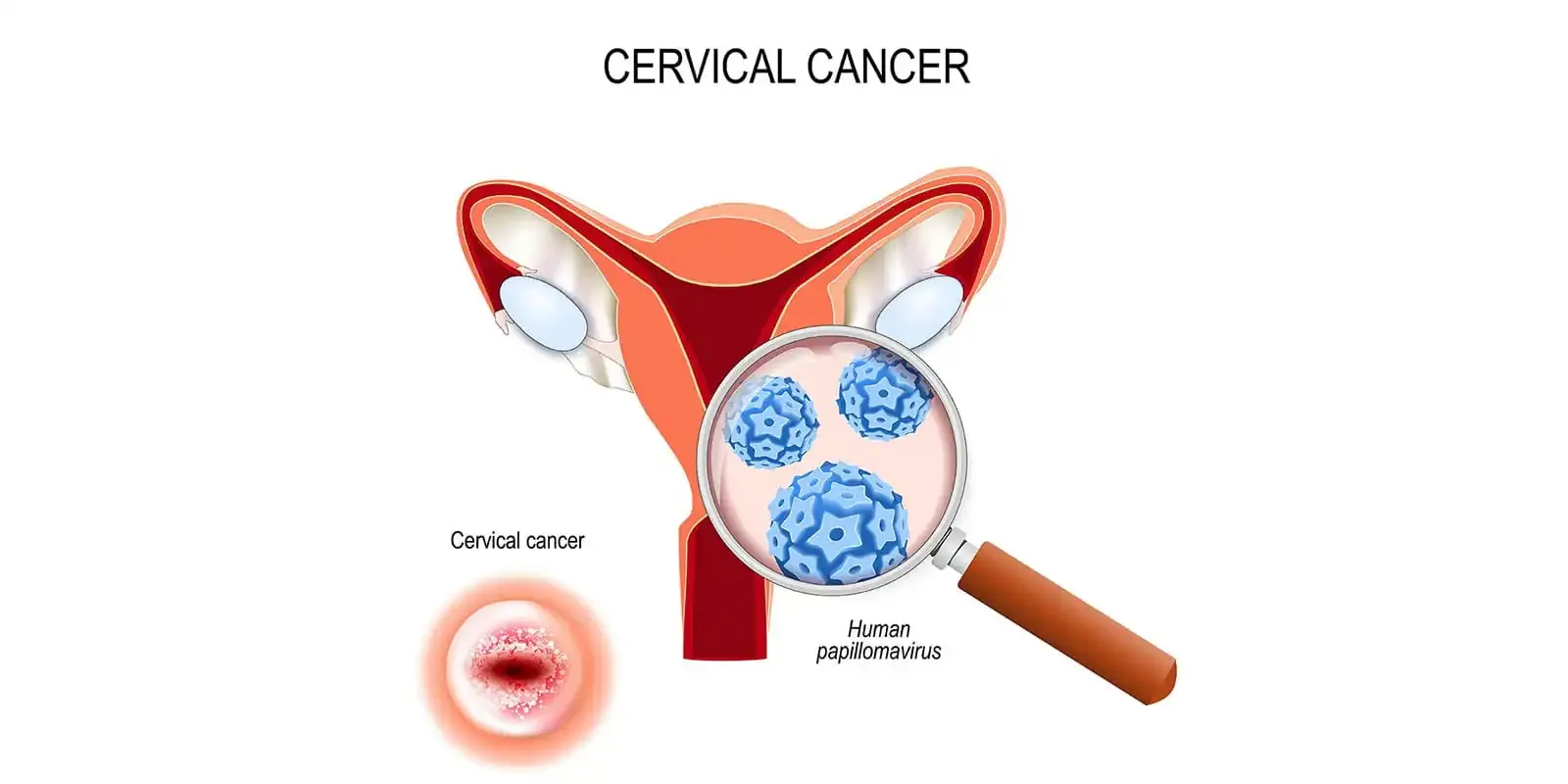 HPV και Κονδυλώματα