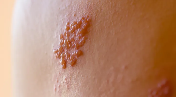 ΦΥΣΑΛΙΔΕΣ ΤΟΥ ΕΡΠΗ